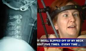 Shannon Malloy Survival Story: Rare Spinal Injury and Extraordinary Recovery